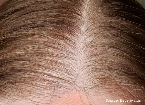 image after hair restoration low level laser light therapy