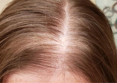 image before hair restoration low level laser light therapy