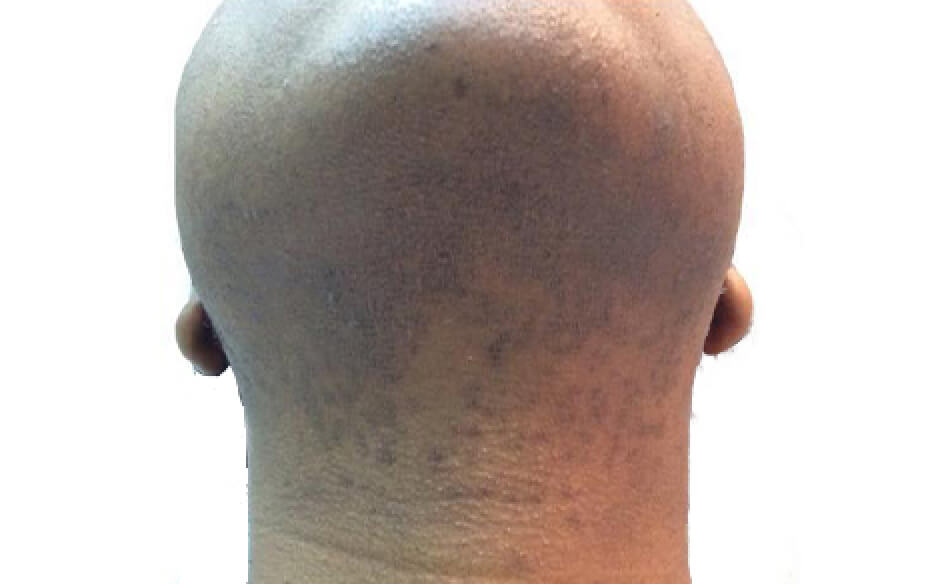 after image of inner laser hair removal