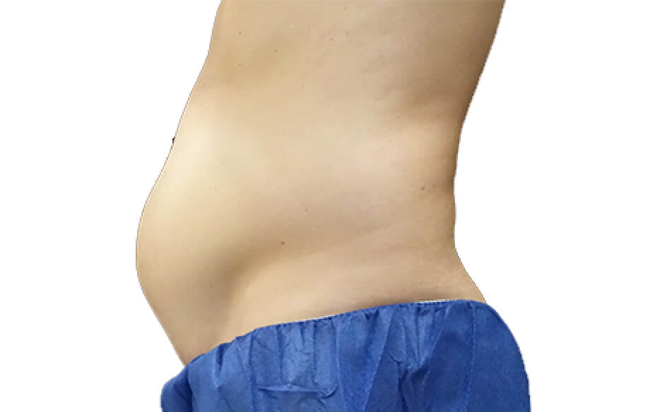 before picture of coolsculpting
