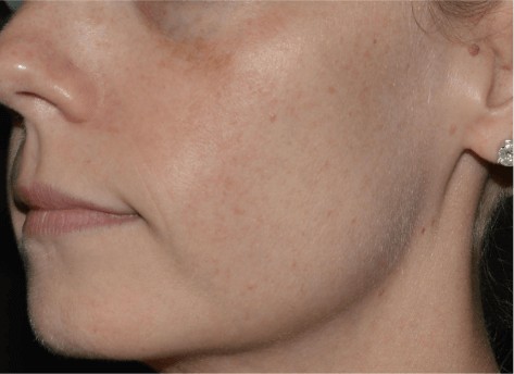 picture of a woman before laser peel