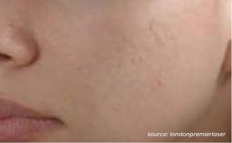 clearer skin of a woman after microneedling