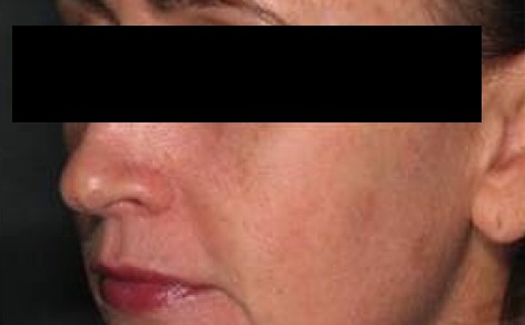 image of a woman after inner skin tightening with lasers