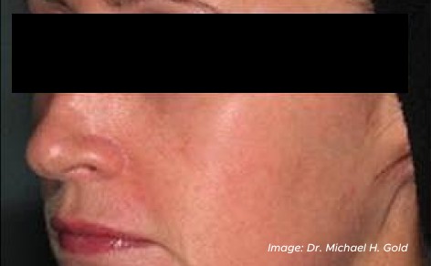 picture of a woman after service skin tightening with lasers