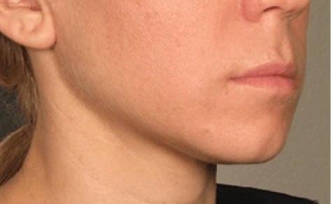 after image of inner skin tightening with ultrasound