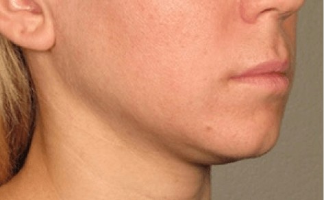 before image of inner skin tightening with ultrasound