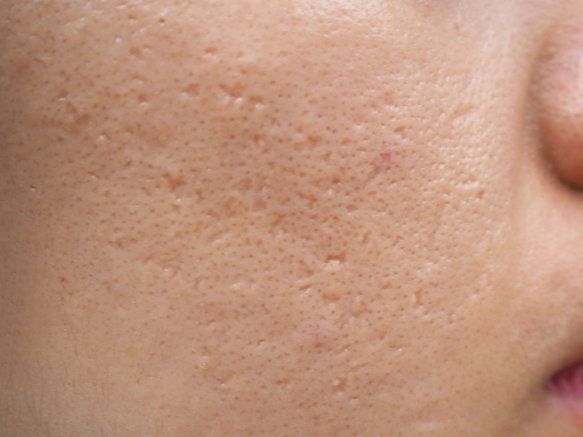 10 Acne Scar Treatments By The Dermatologist