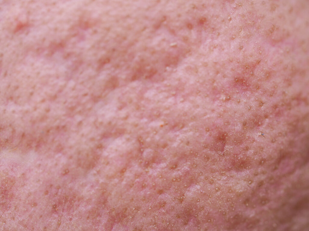yellowish acnes close up
