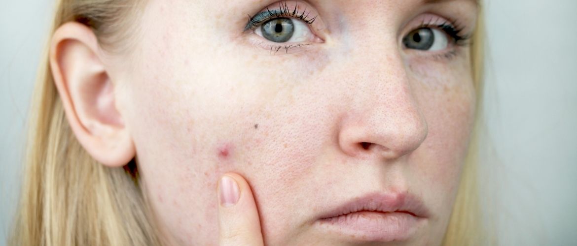 Young Woman with Acne. Applying Ointment to the Pimple.