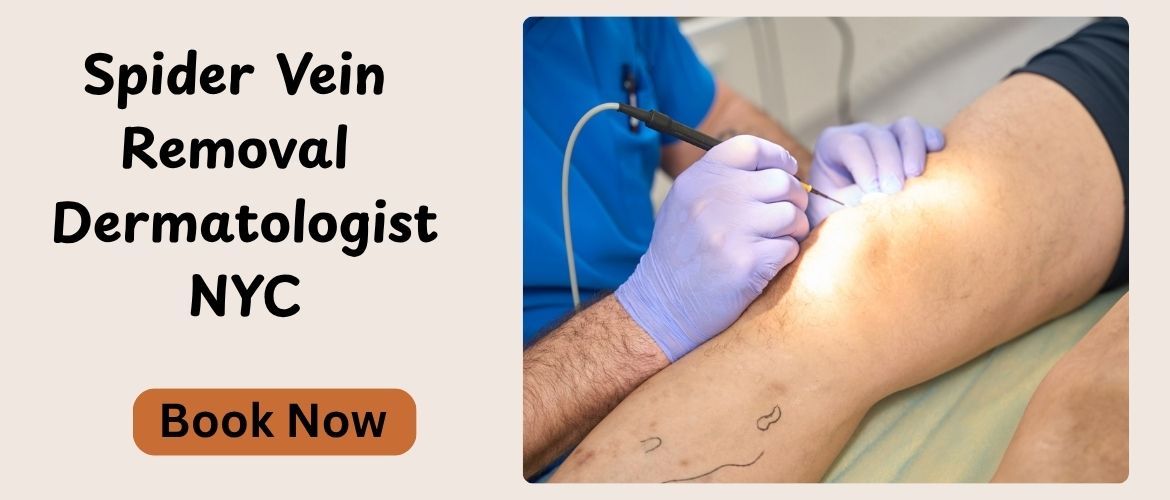 Spider Vein Removal Dermatologist NYC